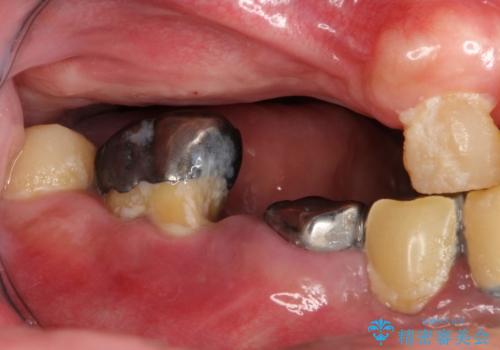虫歯だらけ、歯周病　崩壊した口腔の再建　フルマウスリコンストラクションの治療前