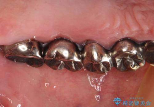 虫歯だらけ、歯周病 崩壊した口腔の再建 フルマウスリコンストラクションの治療前