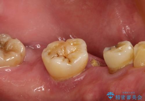 虫歯だらけ、歯周病 崩壊した口腔の再建 フルマウスリコンストラクションの治療前