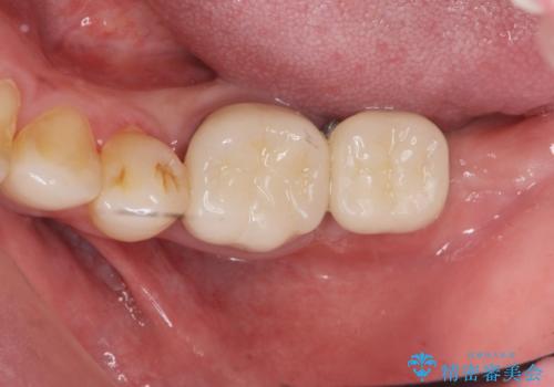 最後方臼歯のインプラント補綴の治療後