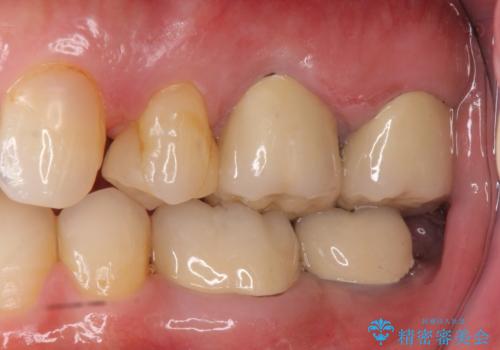 最後方臼歯のインプラント補綴の治療後
