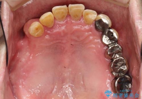 虫歯だらけ、歯周病 崩壊した口腔の再建 フルマウスリコンストラクションの治療前