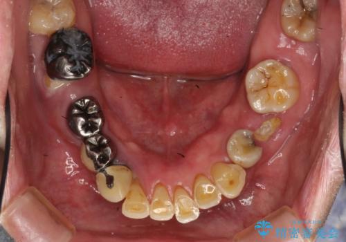 虫歯だらけ、歯周病 崩壊した口腔の再建 フルマウスリコンストラクションの治療前