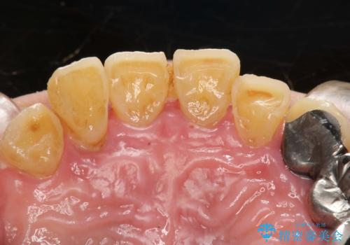 虫歯だらけ、歯周病 崩壊した口腔の再建 フルマウスリコンストラクションの治療前