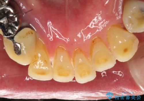 虫歯だらけ、歯周病 崩壊した口腔の再建 フルマウスリコンストラクションの治療前