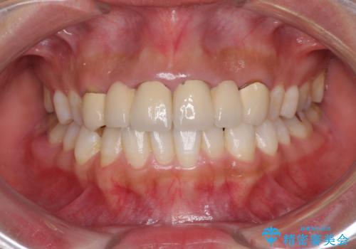 気になる前歯を審美歯科治療と矯正歯科治療で美しくの症例 治療前