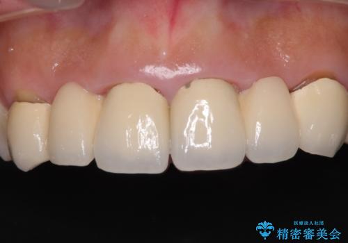気になる前歯を審美歯科治療と矯正歯科治療で美しくの治療前