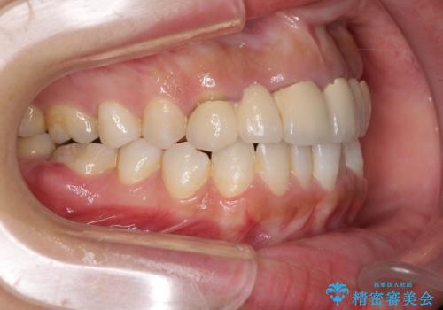気になる前歯を審美歯科治療と矯正歯科治療で美しくの治療前