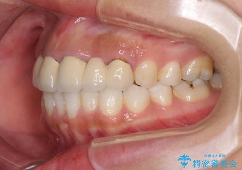 気になる前歯を審美歯科治療と矯正歯科治療で美しくの治療前