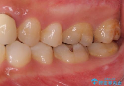 気になる前歯を審美歯科治療と矯正歯科治療で美しくの治療前