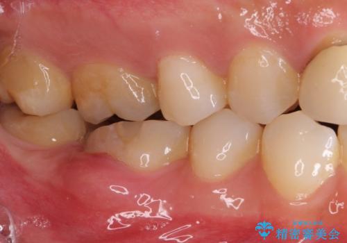 気になる前歯を審美歯科治療と矯正歯科治療で美しくの治療前