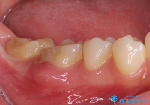 気になる前歯を審美歯科治療と矯正歯科治療で美しくの治療前