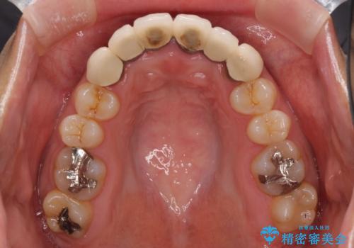 気になる前歯を審美歯科治療と矯正歯科治療で美しくの治療前