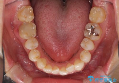 気になる前歯を審美歯科治療と矯正歯科治療で美しくの治療前