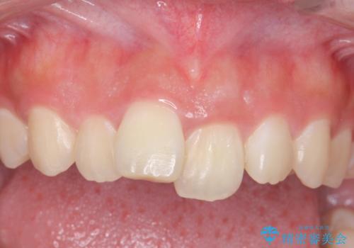 出っ歯をセラミックで治したい の治療前