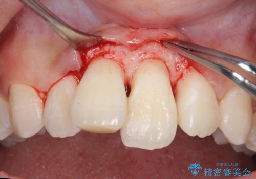 出っ歯をセラミックで治したい の治療中