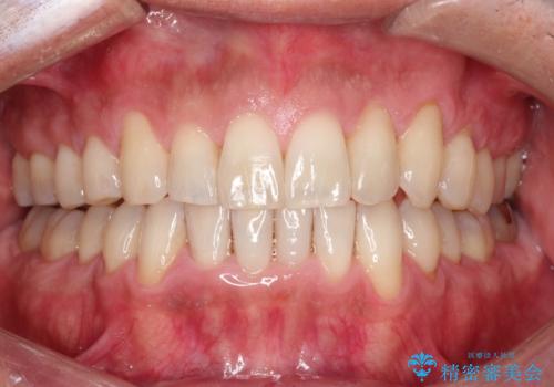 インビザライン invisalign ガタつきを治すマウスピース矯正の症例 治療後