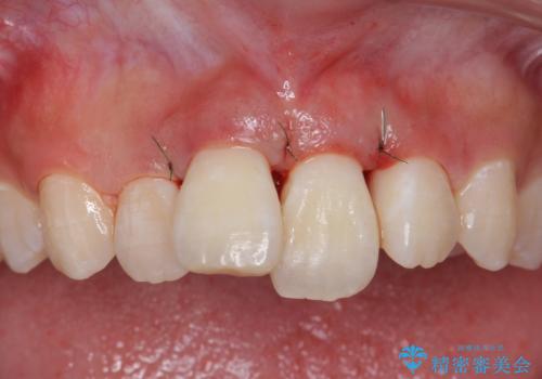 出っ歯をセラミックで治したい の治療中