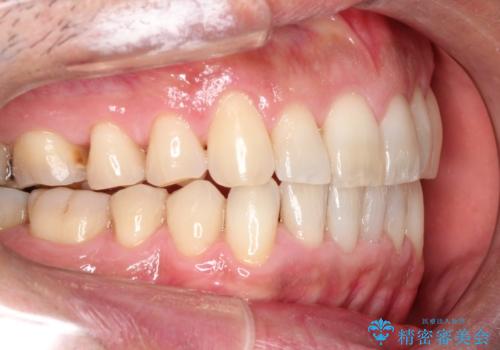 インビザライン invisalign ガタつきを治すマウスピース矯正の治療後