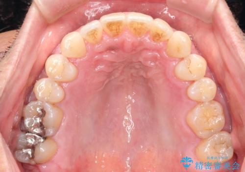 インビザライン invisalign ガタつきを治すマウスピース矯正の治療後