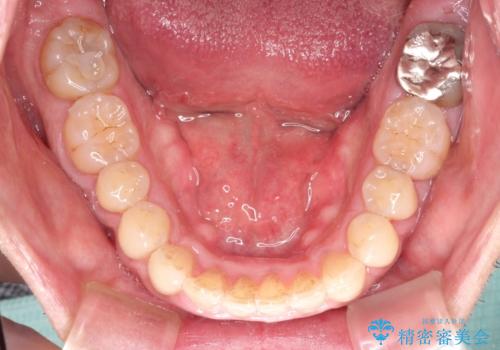 インビザライン invisalign ガタつきを治すマウスピース矯正の治療後
