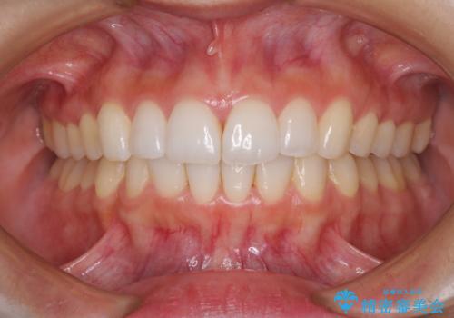 口が閉じにくい 1本飛び出した前歯の矯正治療