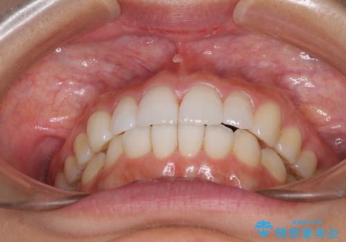 口が閉じにくい　1本飛び出した前歯の矯正治療の治療後