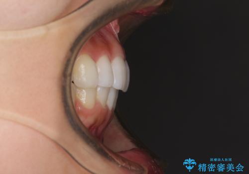 口が閉じにくい 1本飛び出した前歯の矯正治療の治療後