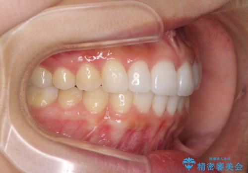 口が閉じにくい 1本飛び出した前歯の矯正治療の治療後