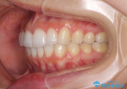 口が閉じにくい 1本飛び出した前歯の矯正治療の治療後