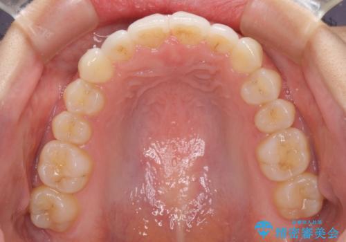 口が閉じにくい 1本飛び出した前歯の矯正治療の治療後
