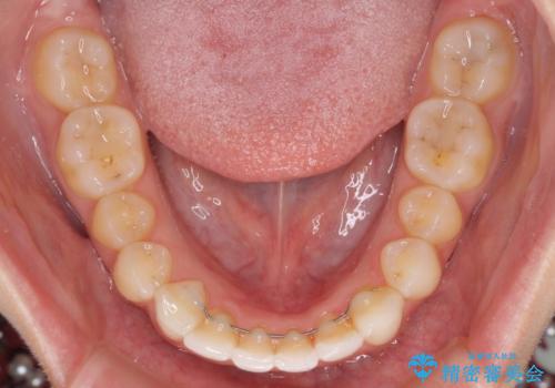 口が閉じにくい 1本飛び出した前歯の矯正治療の治療後