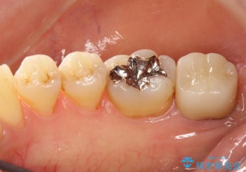 一番奥歯の後ろに虫歯が　処置の難しい虫歯の治療後