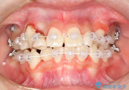 永久歯が生えてこない ワイヤー矯正で複雑な状態を正常咬合へ誘導するの治療中
