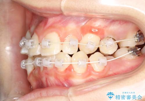永久歯が生えてこない ワイヤー矯正で複雑な状態を正常咬合へ誘導するの治療中