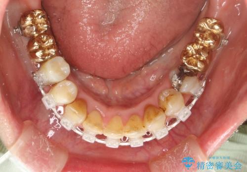 片顎の部分矯正 ワイヤーを用いて短期間でガタつきを改善するの治療中