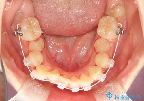 永久歯が生えてこない　ワイヤー矯正で複雑な状態を正常咬合へ誘導するの治療中