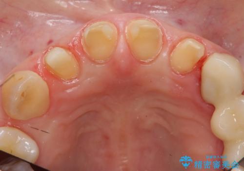 前歯の虫歯　つぎはぎの歯をセラミックにの治療中