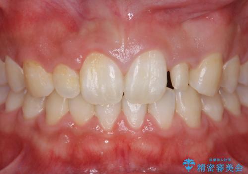 前歯のすきま 矯正治療とセラミックで小さな歯を形良くの治療中