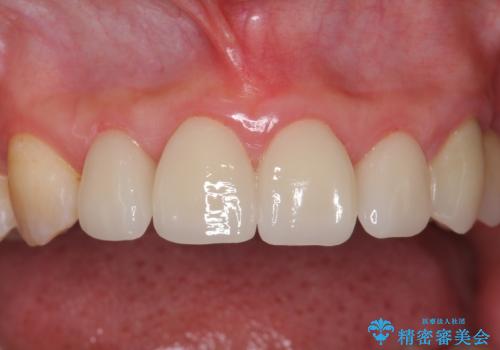 前歯の虫歯　つぎはぎの歯をセラミックにの症例 治療後