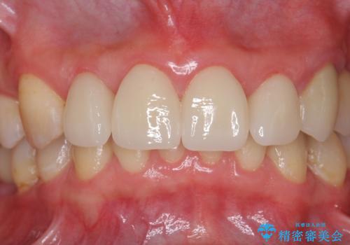 前歯の虫歯　つぎはぎの歯をセラミックにの治療後