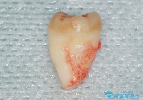 自家歯牙移植 使っていない親知らずを移植 20代女性の治療中