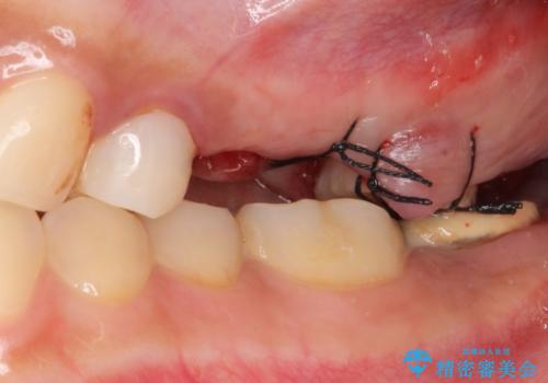 自家歯牙移植 使っていない親知らずを移植 20代女性の治療中