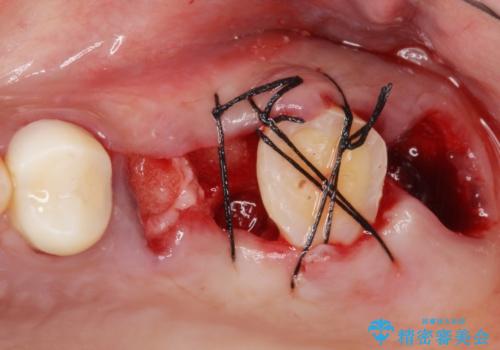 自家歯牙移植 使っていない親知らずを移植 20代女性の治療中