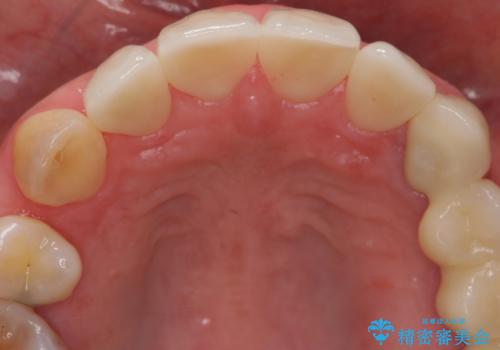 前歯の虫歯　つぎはぎの歯をセラミックにの治療後