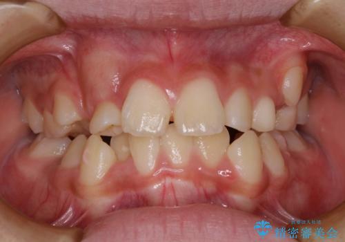 永久歯が生えてこない ワイヤー矯正で複雑な状態を正常咬合へ誘導するの治療前