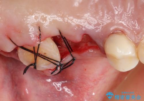 自家歯牙移植 使っていない親知らずを移植 20代女性の治療中