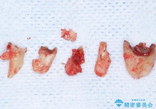 自家歯牙移植 使っていない親知らずを移植 20代女性の治療中