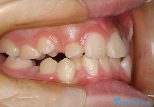 永久歯が生えてこない ワイヤー矯正で複雑な状態を正常咬合へ誘導するの治療前