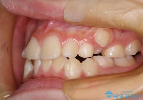永久歯が生えてこない　ワイヤー矯正で複雑な状態を正常咬合へ誘導するの症例 治療前